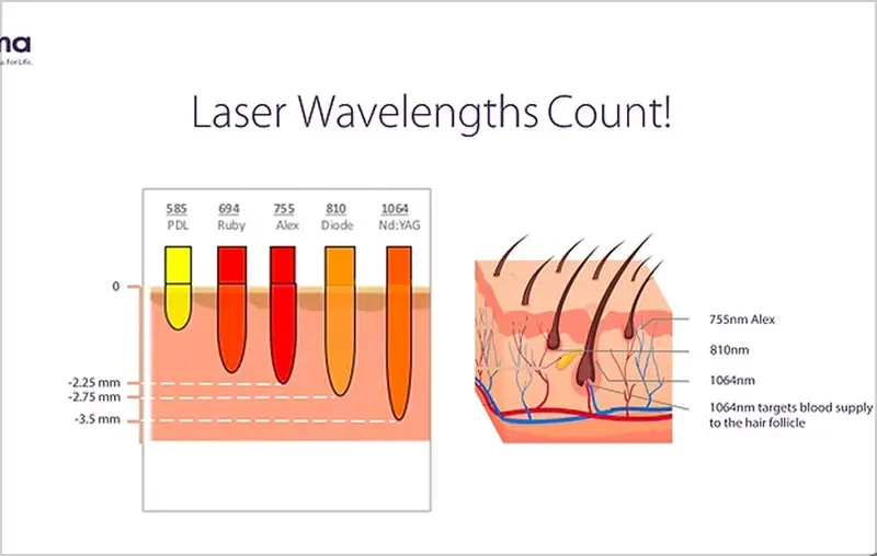 Technology: Pain-free & effective
treatment with Soprano Titanium